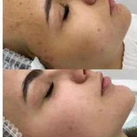 فیشیال تخصصی پوست|خدمات آرایشگری و زیبایی|سبزوار, فرهنگیان|دیوار