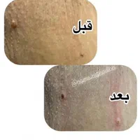 پاکسازی لیزرخالبرداری،توسط پزشک|خدمات آرایشگری و زیبایی|کارون, |دیوار