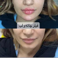 کلینیک تزریق ژل و بوتاکس انزیم پزشک|خدمات آرایشگری و زیبایی|کرج, گوهردشت|دیوار