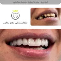 تخفیف ویژه جرمگیری و بلیچینگ (سفید کردن دندان)|خدمات آرایشگری و زیبایی|تهران, امیریه|دیوار