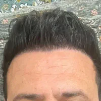 کاشت مو پر تراکم با خط رویش کاملا طبیعی