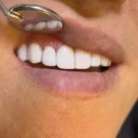 کامپوزیت دندان|خدمات آرایشگری و زیبایی|اسلام‌شهر, شهرک مهدیه|دیوار