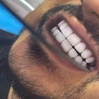 جشنواره کامپوزیت دندان|خدمات آرایشگری و زیبایی|فردیس, فردیس|دیوار