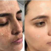 کرم سفید کننده ی عروس بندر|آرایشی، بهداشتی، درمانی|بندرعباس, |دیوار