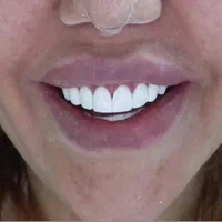 کامپوزیت زیبایی دندانپزشکی|خدمات آرایشگری و زیبایی|یاسوج, |دیوار