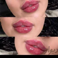 ژل فیلر بوتاکس مزو لیزر هایفو فیشیال خال مطب سلامت|خدمات آرایشگری و زیبایی|تبریز, |دیوار