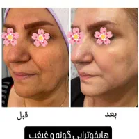 کیوسوئیچ، لیزر موهای زائد، هایفو، جوانسازی|خدمات آرایشگری و زیبایی|آبادان, |دیوار