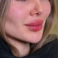 تخفیف ویژه مزو،آنزیم،ژل با بیحسی دندانپزشکی از ۴۰۰|خدمات آرایشگری و زیبایی|گرگان, |دیوار