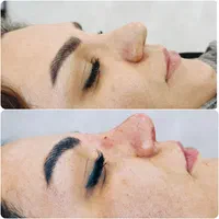 لیفت صورت با نخ. ژل.بوتاکس.مزوژل. درکلینیک|خدمات آرایشگری و زیبایی|کرمانشاه, |دیوار