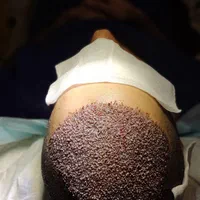 خدمات زیبایی کاشت مو|خدمات آرایشگری و زیبایی|یاسوج, |دیوار