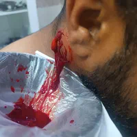 فصد پیشانی ،خالبرداری حجامت ، زالو و بادکش|خدمات آرایشگری و زیبایی|اهواز, کوی مهدیس|دیوار