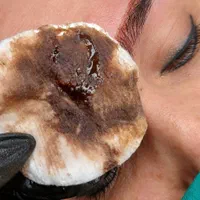 مرکز تخصصی ریمو ابرو ( پاک کردن تتو ابرو ، لب چشم