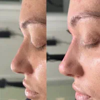 آموزش و انجام خدمات زیبایی ژل، بوتاکس ، آنزیم.مزو|خدمات آرایشگری و زیبایی|بروجرد, |دیوار