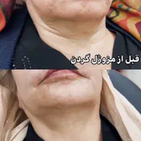 تزریق مزوژل جوانساز ویتن کُره کلینیک زیبایی|خدمات آرایشگری و زیبایی|تهران, تهرانسر شرقی|دیوار