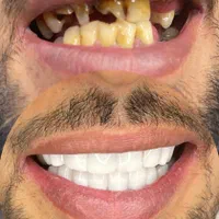 کامپوزیت دندان|خدمات آرایشگری و زیبایی|سبزوار, کاشفی شمالی (دادگستری)|دیوار