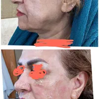 هایفو /فیلر/لک/ککمک/لیزر لاغری مزوتراپی