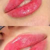 ژل بوتاکس فیلرمادلینگ هایفو لیزر فشیال مطب سلامت
