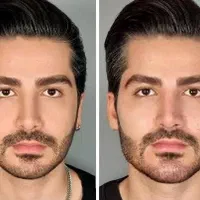 فیلر هایفو لاغری چربی لیزر پی آر پی مزو نخ|خدمات آرایشگری و زیبایی|تبریز, |دیوار