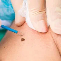 خالبرداری بدون جراحی در کلینیک زیبایی و لیزر راویس|خدمات آرایشگری و زیبایی|کاشان, رجایی|دیوار