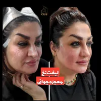 لیفت نخ معجزه جوانی و لیفتینگ صورت بدون جراحی|خدمات آرایشگری و زیبایی|شاهین‌شهر, فردوسی|دیوار