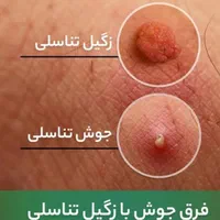 درمان زگیل،تبخال تناسلی خانمهاو آقایان،درمطب متخصص|خدمات آرایشگری و زیبایی|تبریز, |دیوار