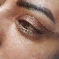 جراحی عمل پلک/بلفاروپلاستی/ساکشن غبغب/سانترال لب|خدمات آرایشگری و زیبایی|کرج, عظیمیه|دیوار