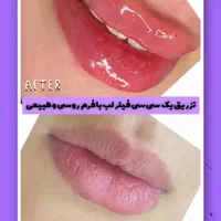 تزریق فیلر ژل بوتاکس هایفو فشیال لیزرکاملا اقساطی|خدمات آرایشگری و زیبایی|اردبیل, |دیوار
