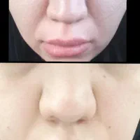 آموزش کوچک کردن بینی فیلرژل و بوتاکس آنزیم|خدمات آرایشگری و زیبایی|مشهد, آزادشهر|دیوار