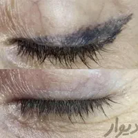 کلینیک پاک کردن تاتو(لیزرتضمینی)دریک جلسه/ریموابرو|خدمات آرایشگری و زیبایی|مشهد, احمدآباد|دیوار