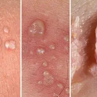 درمان زگیل،تبخال تناسلی خانمهاو آقایان،درمطب متخصص