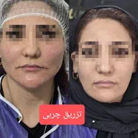 تزریق ژل وبوتاکس و لیزر موی زایدولیزر پاک کردن تتو|خدمات آرایشگری و زیبایی|نسیم‌شهر, |دیوار