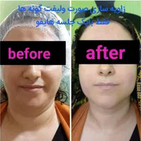 هایفو صورت،واژن.لیفت ابرو.لاغری ژل آنزیم مزو|خدمات آرایشگری و زیبایی|مشهد, آزادشهر|دیوار