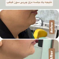 درمان تخصصی ریزش و قطع ریزش مو در کلینیک تخصصی|خدمات آرایشگری و زیبایی|برازجان, |دیوار