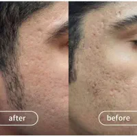 درمان همیشگی تورفتگی پوستی/ جای جوش/اسکار/سالک|خدمات آرایشگری و زیبایی|اصفهان, احمدآباد|دیوار
