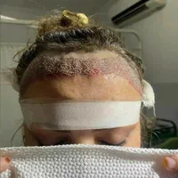 کاشت موی طبیعی|خدمات آرایشگری و زیبایی|اهواز, زیتون کارمندی|دیوار