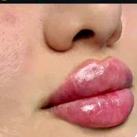 تزریق ژل بوتاکس پی ارپی درکلینیک|خدمات آرایشگری و زیبایی|کرمانشاه, |دیوار