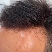 فروش اقساطی انواع پروتز مو فقط اورجینال|آرایشی، بهداشتی، درمانی|تهران, کوی فردوس|دیوار