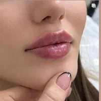 ژل /بوتاکس فیلر لب روسی اموزش بوتاکس آنزیم چربی