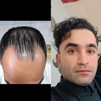 کاشت مو وابرو وریش(نقد واقساط ) اقساطی|خدمات آرایشگری و زیبایی|شیراز, بعثت|دیوار