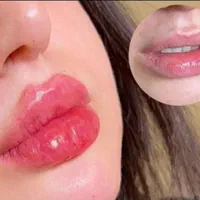 تخفیف ویژه پی ار پیprpفیلرژل بوتاکس کامپوزیت|خدمات آرایشگری و زیبایی|اهواز, کیان اباد|دیوار