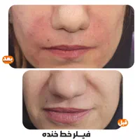 فیلر چروک های صورت|خدمات آرایشگری و زیبایی|شوش, |دیوار