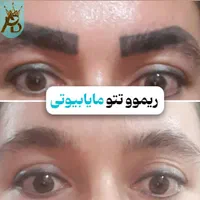 پاک کردن تتو خالکوبی،ریموو تتو ابروـ بدن مایابیوتی