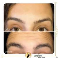 ژل لب روسی/بوتاکس/فیلر زیر چشم/زاویه فک لیزر بدن|خدمات آرایشگری و زیبایی|تهران, ستارخان|دیوار