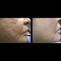 تخصصی پی آر پیprp مزو بوتاکس فیلر ژل حجامت فصد|خدمات آرایشگری و زیبایی|اصفهان, جلفا|دیوار
