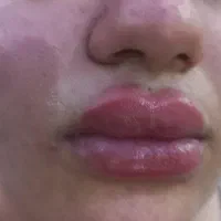 بوتاکس وژل.مزوسر   فقط۳۵۰|خدمات آرایشگری و زیبایی|کرج, بنیاد|دیوار
