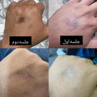 دستگاه Co2 فرکشنال ناب وی ۲۰۲۵|پزشکی|شیراز, ارم|دیوار