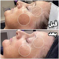 بوتاکس،مزوتراپی مو،ابرو،حذف خال زگیل،جای زخم وبخیه|خدمات آرایشگری و زیبایی|اسلام‌شهر, شهرک قائمیه|دیوار