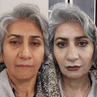 کلینیک زیبایی ژل و فیلر،بوتاکس و لیزر،جراحی پلک|خدمات آرایشگری و زیبایی|فردیس, فردیس|دیوار
