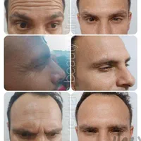 جشنواره تابستانه تزریق ژل وبوتاکس توسط پزشک متخصص