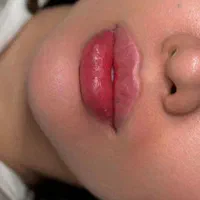 تزریقات ژل و بوتاکس ۷۹۰